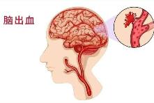 腦出血2小時內(nèi)強化降壓 可減少致殘致死風險